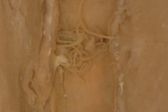 D. filaria - dospelce vo veľkých bronchoch (makropreparát - detail)