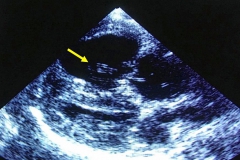 D. imitis - zobrazenie červov počas USG vyšetreníiav srdci psa (orig. foto: Dr. J. Torzewski)