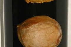 E. granulosus - hydatidózna cysta v MH